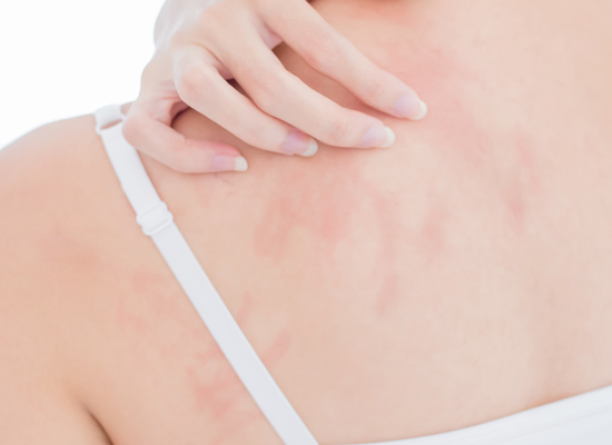 ECZEMA